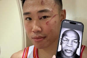 贺希宁晒脸部伤痕对比拳王泰森：如果这是赢球的代价 我愿意?